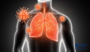 Lire la suite à propos de l’article Diagnostic de la pneumonie