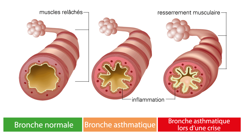 bronche asthmatique, labosalem